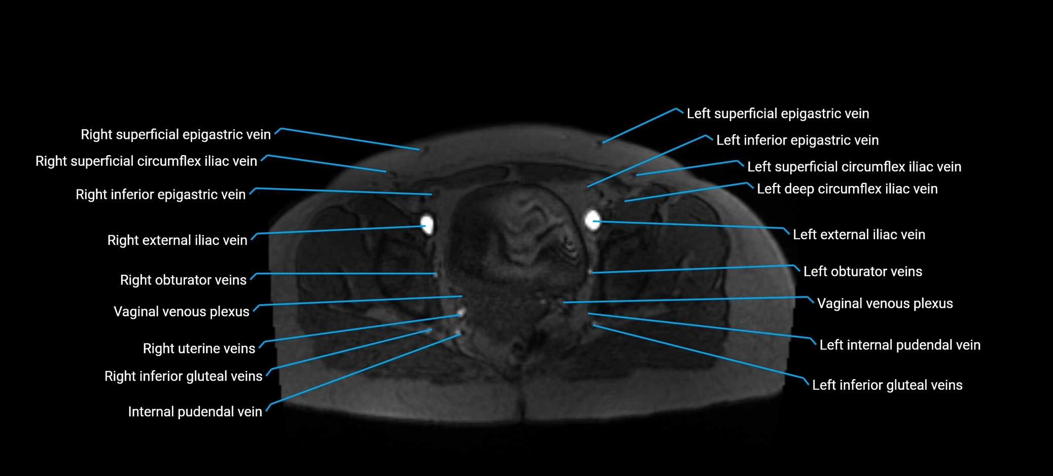 MRV abdomen pelvis & lower limb axial cross sectional anatomy labelled MRI image 172 (1).webp